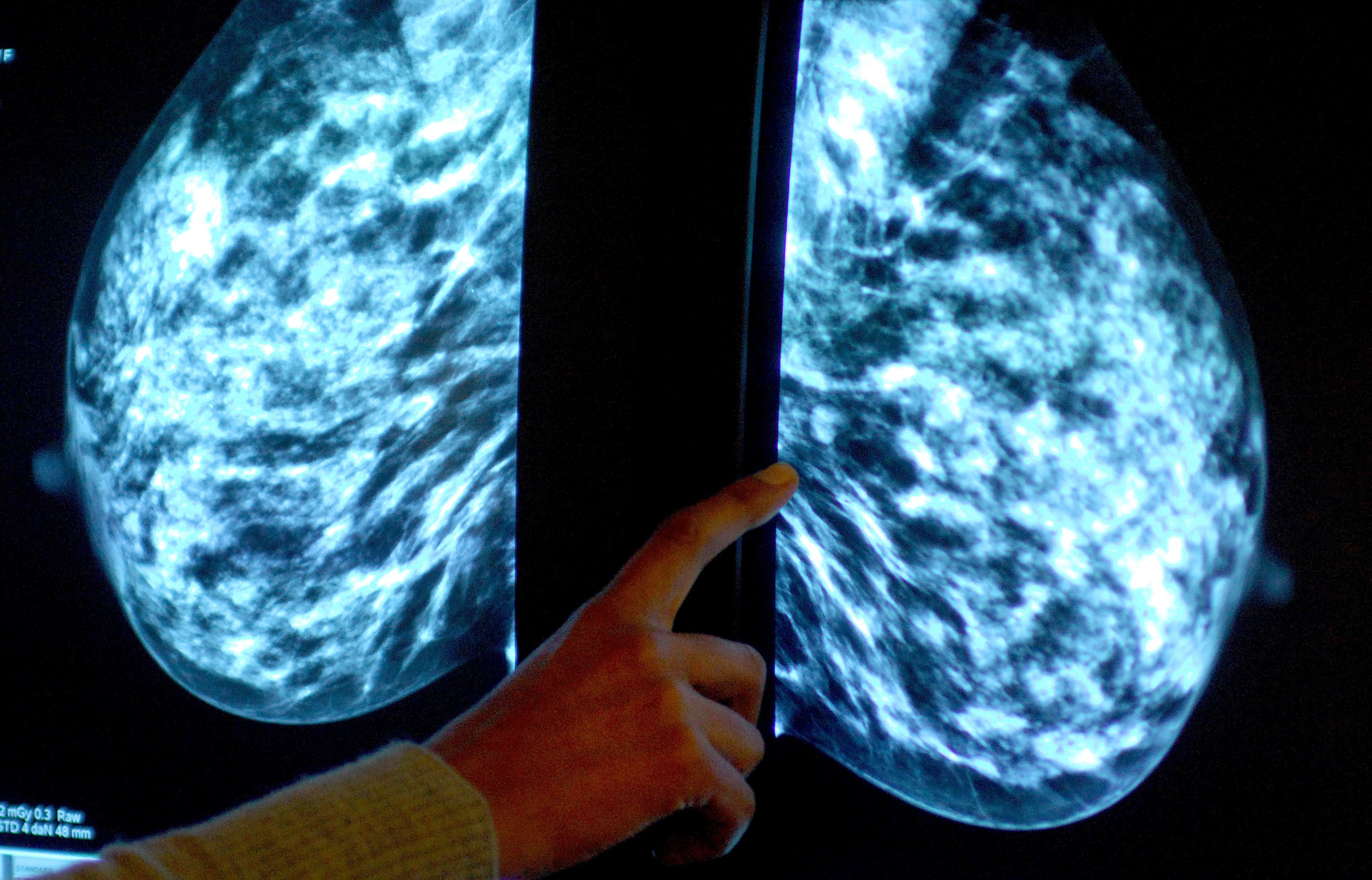 Breast screening uptake in Hampshire, Southampton and the Isle of Wight increases